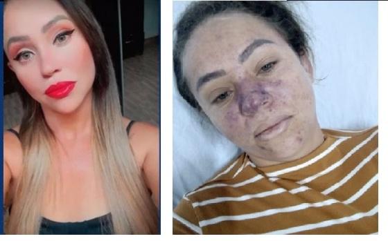 A vítima antes e depois de contrair a doença