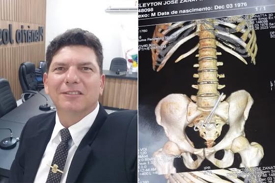 Vereador de MT passa por nova cirurgia após tesoura ser esquecida em abdômen durante retirada de tumor.