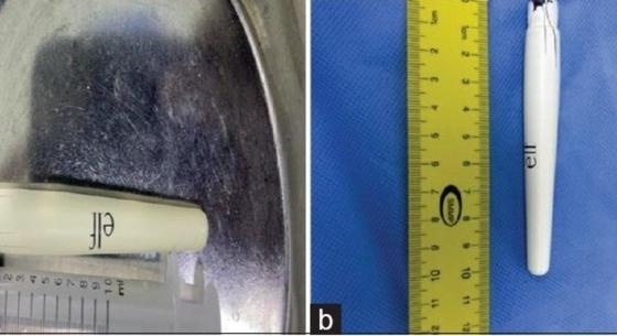 Médicos removem caneta de 10 cm da bexiga de adolescente