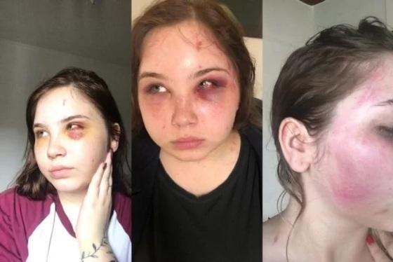 Kauane Cellarius após ser agredida pelo pai, o cantor sertanejo Fernando Rodrigo Cellarius.