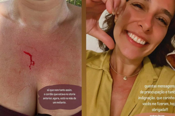 Mulher de William Bonner, Natasha Dantas se machuca em furto