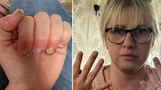 Mulher sofre reação alérgica bizarra após alongamento de unhas com gel.