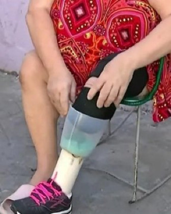 Mulher cria prótese com liquidificador após longa espera por equipamento