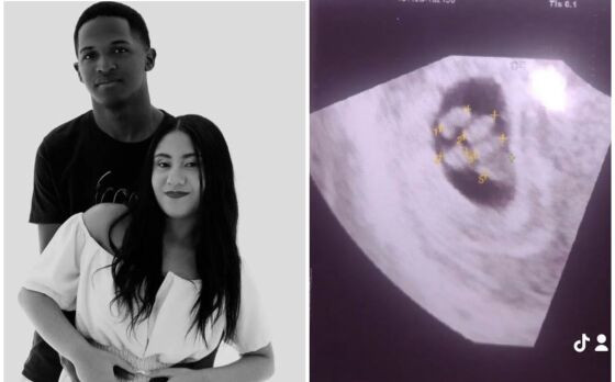 Jovem grávida de quíntuplos sofre aborto espontâneo