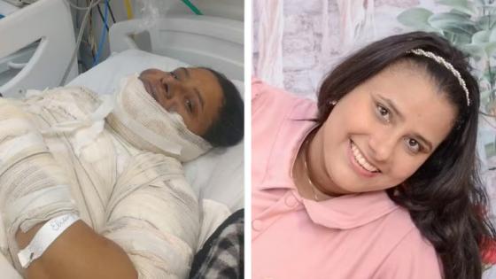 Mulher Morre após sofrer graves queimaduras ao fritar um ovo