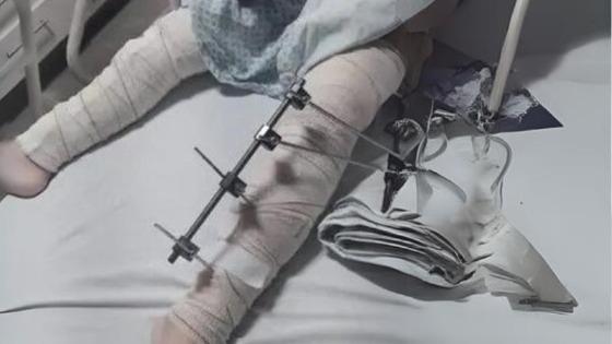 Hospital opera perna errada de criança em cirurgia de emergência: Equipe é investigada 