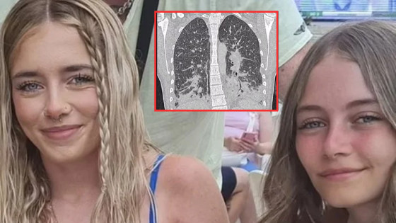 Irmãs de 19 e 17 anos sofrem colapso no pulmonar após excessivo de cigarro eletrônico