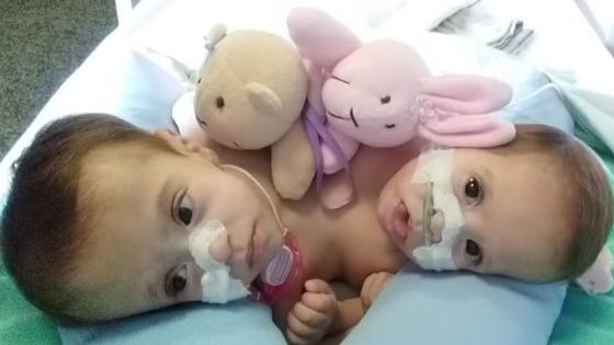Gêmeas siamesas deixam hospital após 9 meses: Caso é o mais complexo para especialista