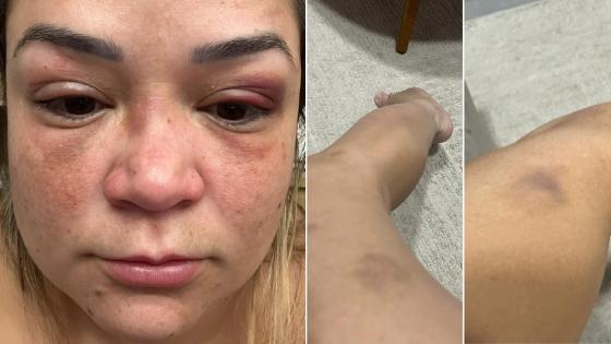 Advogada presa por agressão nega acusações e mostra hematomas: “atordoada de tanta paulada”.