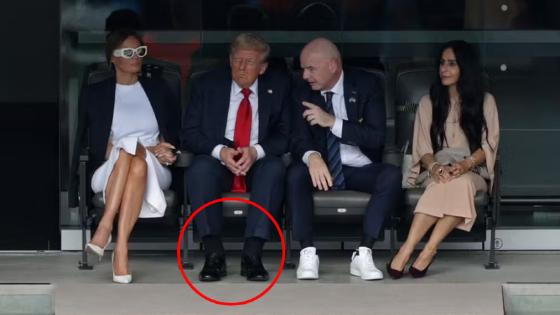Trump é diagnosticado com insuficiência venosa crônica